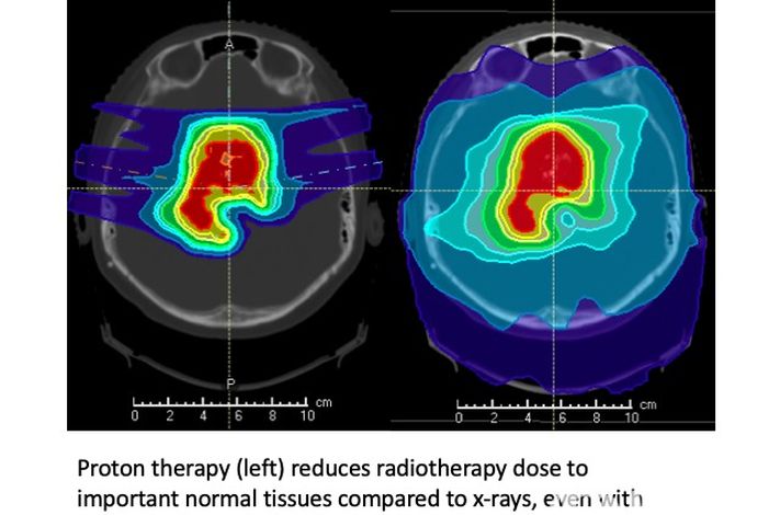 Proton Therapy SG