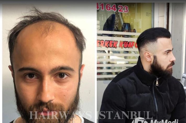 Hairways Istanbul Hair Transplant Clinic