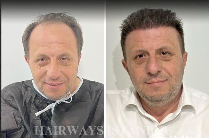 Hairways Istanbul Hair Transplant Clinic