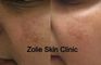Zolie Skin Clinic - Guragaon