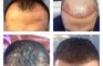 Better Hair Transplant Clinics - Nottingham