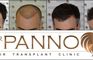 Hair Transplant Malaga Dr. Panno