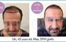 Longevita Hair Transplant - Izmir