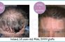 Longevita Hair Transplant - Izmir