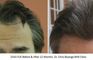 Bisanga Hair Restoration