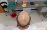 Medical Hair Restoration, Cape Town