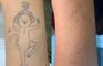 PHU TON - Laser Tattoo Removal