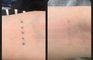 PHU TON - Laser Tattoo Removal