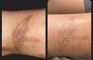 PHU TON - Laser Tattoo Removal